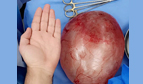 Maternity and Children Hospital in Al-Ahsa Excises Tumor from the Ovary of 18-Year Old Woman
