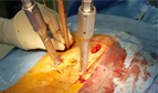 Successful Non-Surgical Spinal Fixation at King Fahad Hospital in Madinah