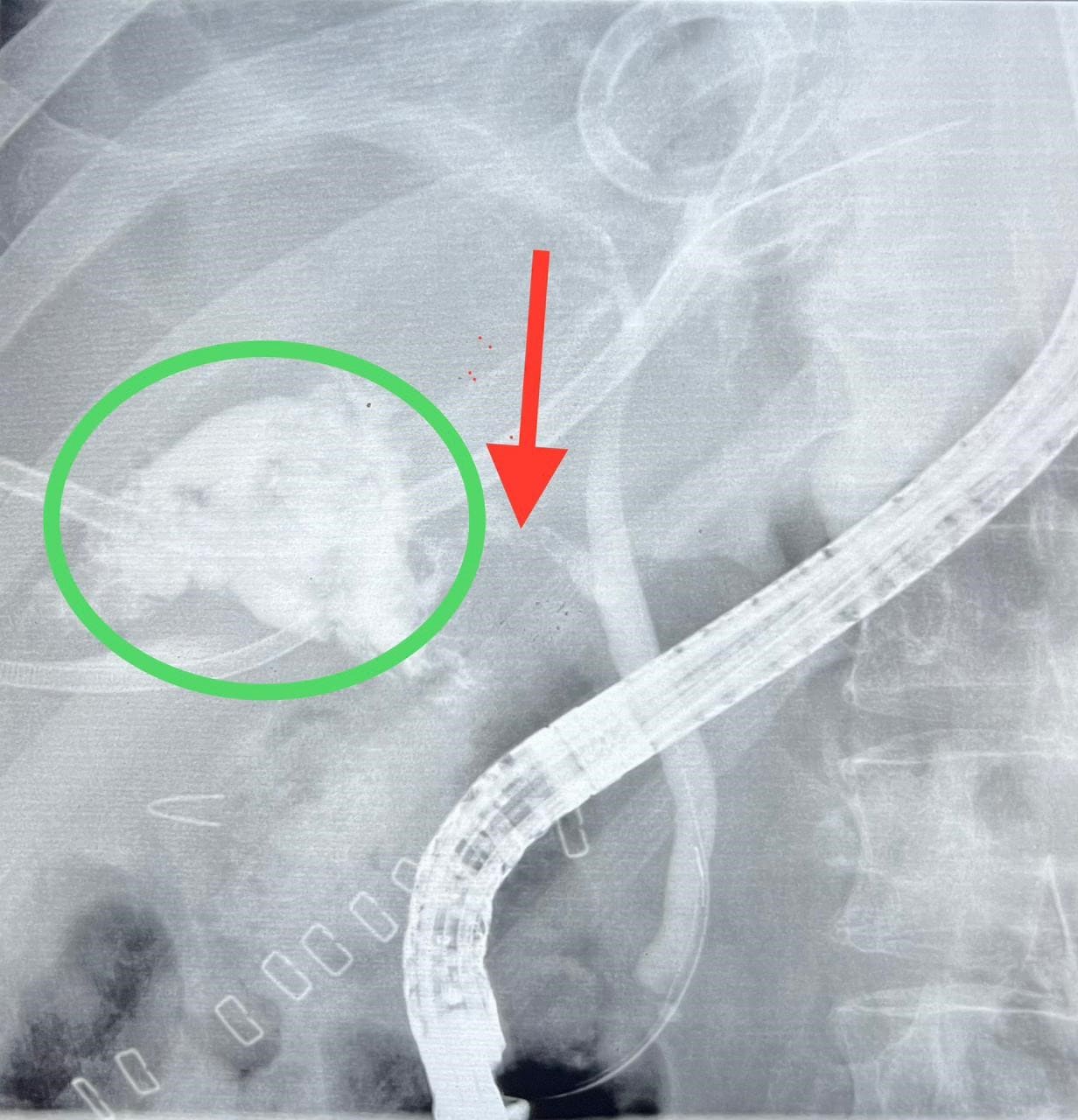 A successful Laparoscopy Operation for a Pilgrim in the "MOH Convoy" then "Stood at Arafah and Ate the Hadi'e"