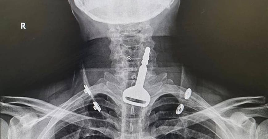 Surgical Intervention Saves the Life of a Patient Swallowed his Car Key