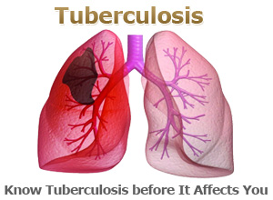 Tuberculosis01_pageImg.jpg