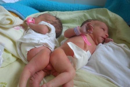 The King Orders Treatment of Conjoined Algerian Twins