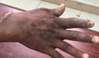 (الصحة): فريق طبي ينجح في إنقاذ يد مقيم من البتر