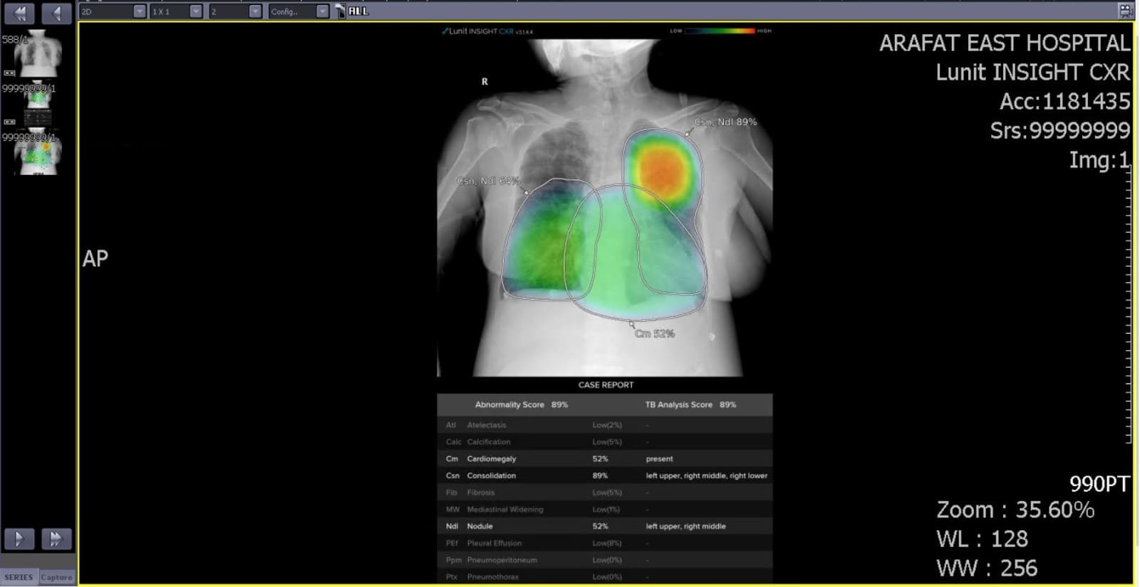 مستشفى "صحة" الافتراضي يفعّل استخدام الذكاء الاصطناعي لتحليل الأشعة السينية لخدمة الحجاج